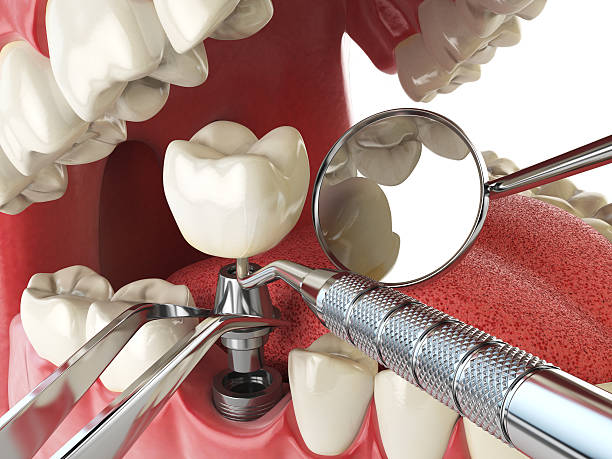 Best Emergency Root Canal Treatment in Evendale, OH